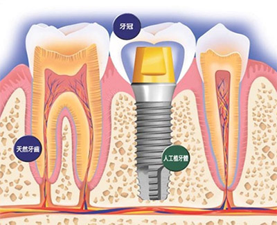 人工植牙