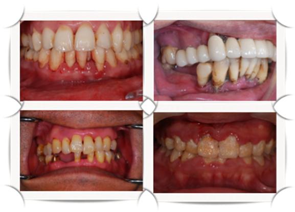 牙周病症狀