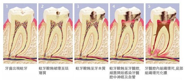 根管治療