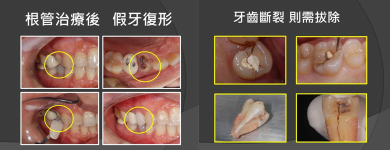 根管治療