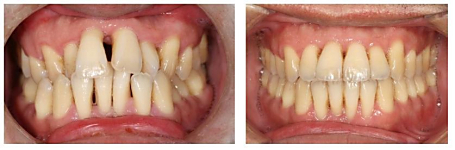 牙周病患者齒顎矯正