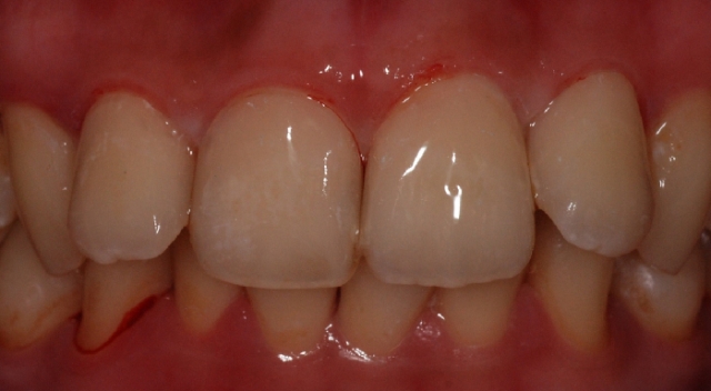 前牙美觀 - 樹脂填補