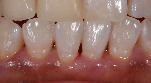 牙齒美白 之 2