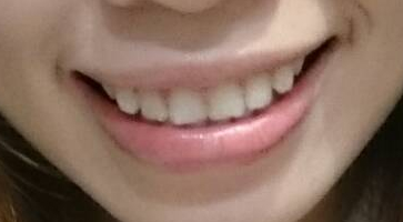 牙齒美白 之 1
