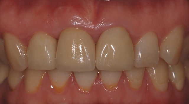 拔牙 立即植牙+補骨 - 02(軟組織移植)