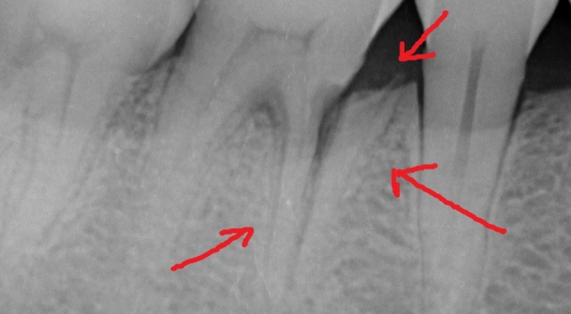 拔牙 立即植牙+補骨 - 07(齒裂)