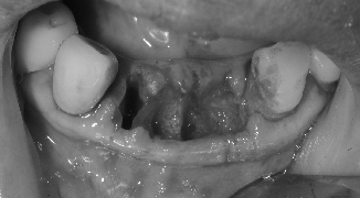 拔牙 立即植牙+補骨 - 04(立即負載-2)