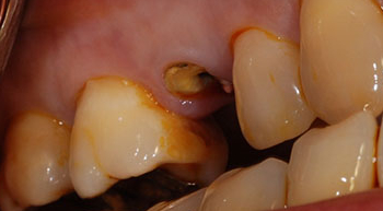 拔牙 立即植牙+補骨 - 05(右上小臼齒完成)